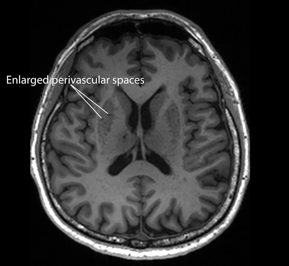 Routine MRI May Reveal Early Alzheimer’s Warning: Blocked Brain 'Drains' Linked to Risk - Image 1