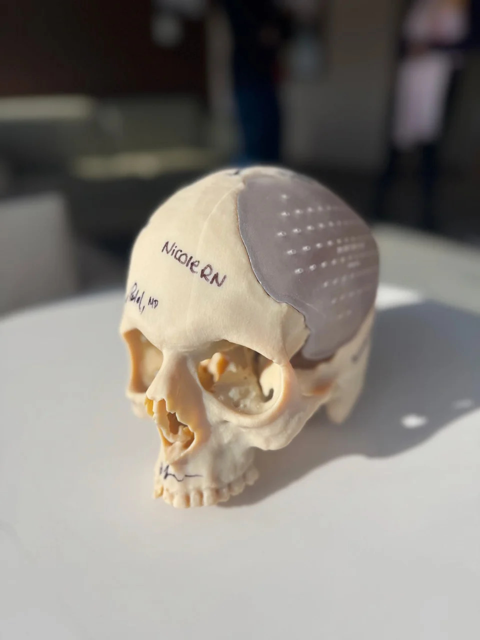 I Lost Nearly Half My Skull — A Custom 3D-Printed Implant Saved My Life - Image 1