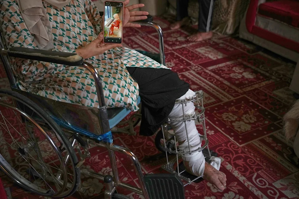 “My Future Is Paralyzed”: Gaza Amputees Struggle as Prosthetics Shortage and Slow Medevac Stall Lives - Image 2
