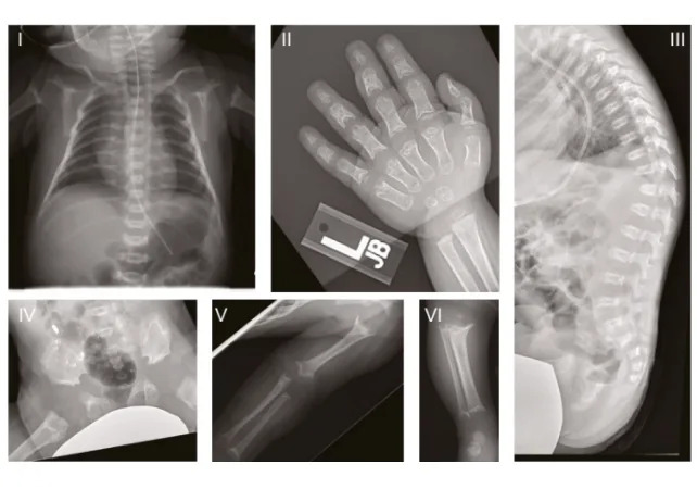 Ultra-Rare GPX4 Mutation Reveals How Neurons Die — Ferroptosis May Drive Neurodegeneration - Image 1