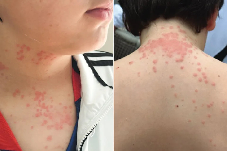 Virginia Family Sues Delta and KLM for $200,000, Alleging Bed-Bug Infestation on Transatlantic Flight - Image 1