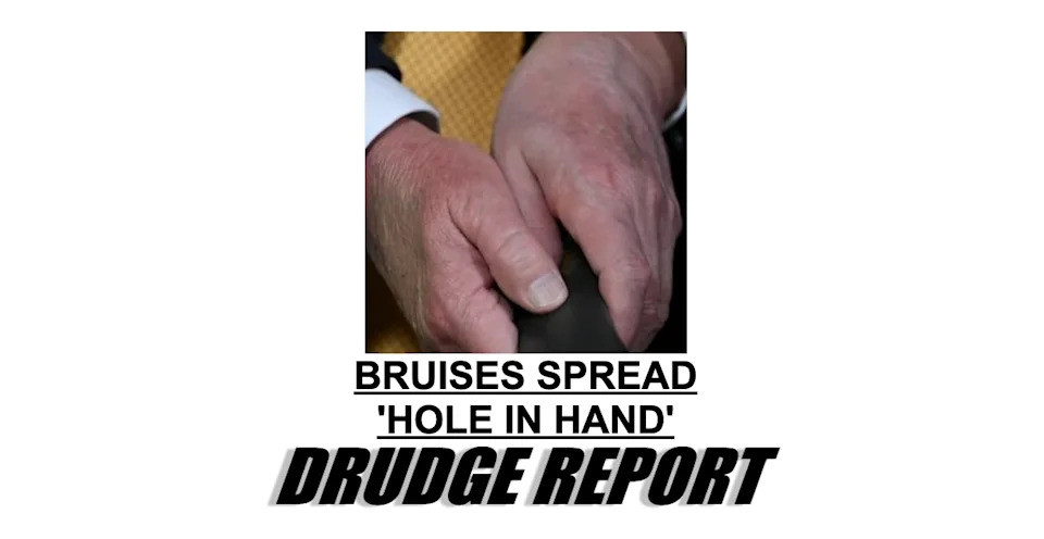 Drudge Report Amplifies Concerns Over Trump’s Bruised Hands and ‘Hole in Hand’ Claims