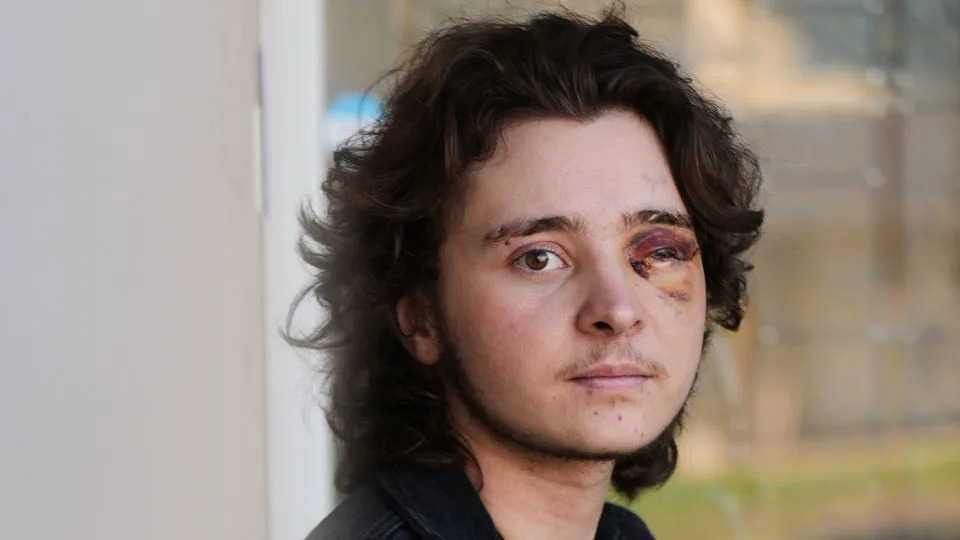 Blood, Pain and Panic: Protesters Describe the Lasting Harm of 'Less-Lethal' Crowd-Control Weapons