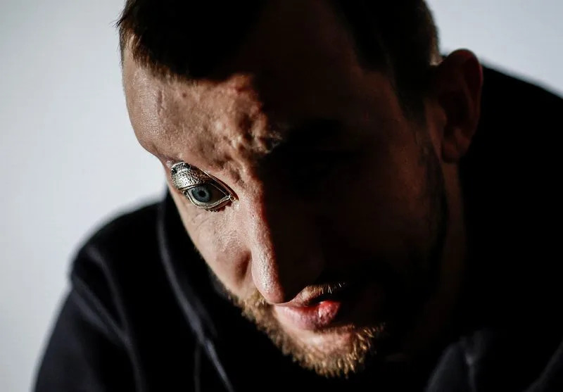 From Frontlines to Footlights: Wounded Ukrainian Veterans Heal and Find Purpose Through Theatre