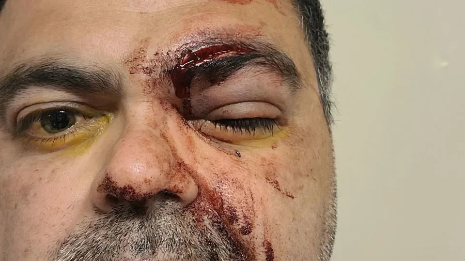 Blood, Pain and Disorientation: Protesters Describe Harms From 'Less-Lethal' Crowd-Control Weapons