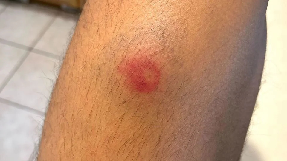 Blood, Pain and Disorientation: Protesters Describe Harms From 'Less-Lethal' Crowd-Control Weapons