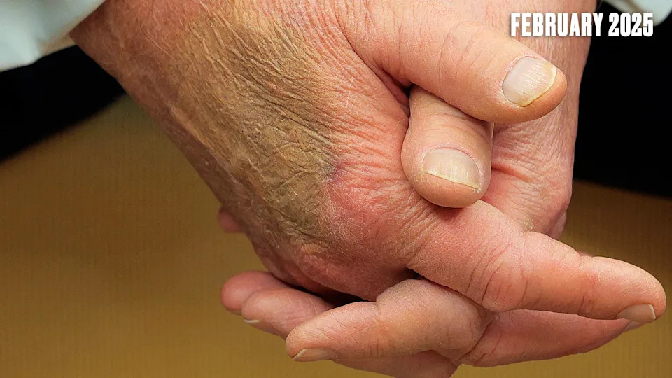 White House Labels Daily Beast Reporter 'Mentally Ill' After Questioning Trump's Bruised Hand — Media Scrutiny Intensifies