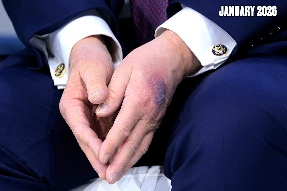 White House Labels Daily Beast Reporter 'Mentally Ill' After Questioning Trump's Bruised Hand — Media Scrutiny Intensifies