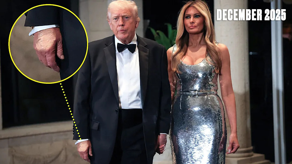 White House Labels Daily Beast Reporter 'Mentally Ill' After Questioning Trump's Bruised Hand — Media Scrutiny Intensifies