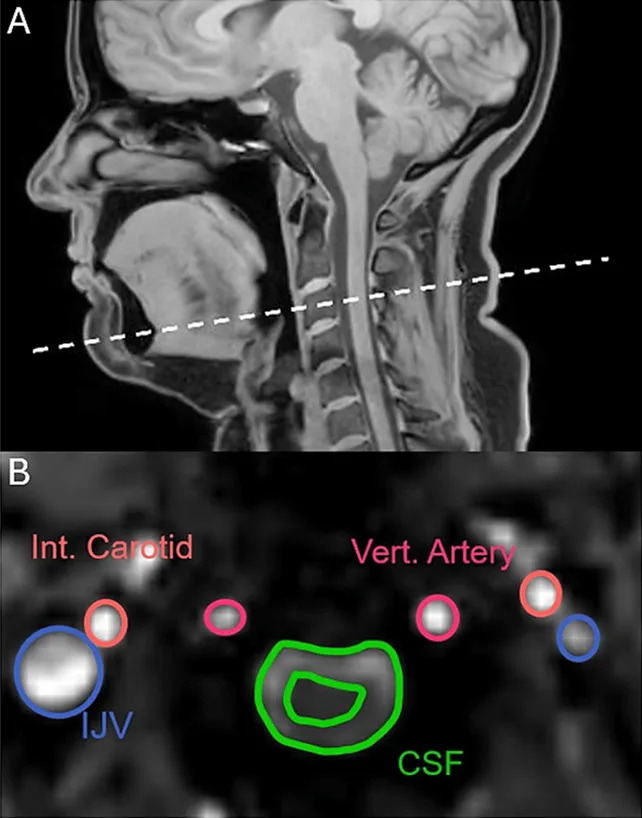 MRI Study Finds Yawns Push Protective Brain Fluid Away — What That Might Mean