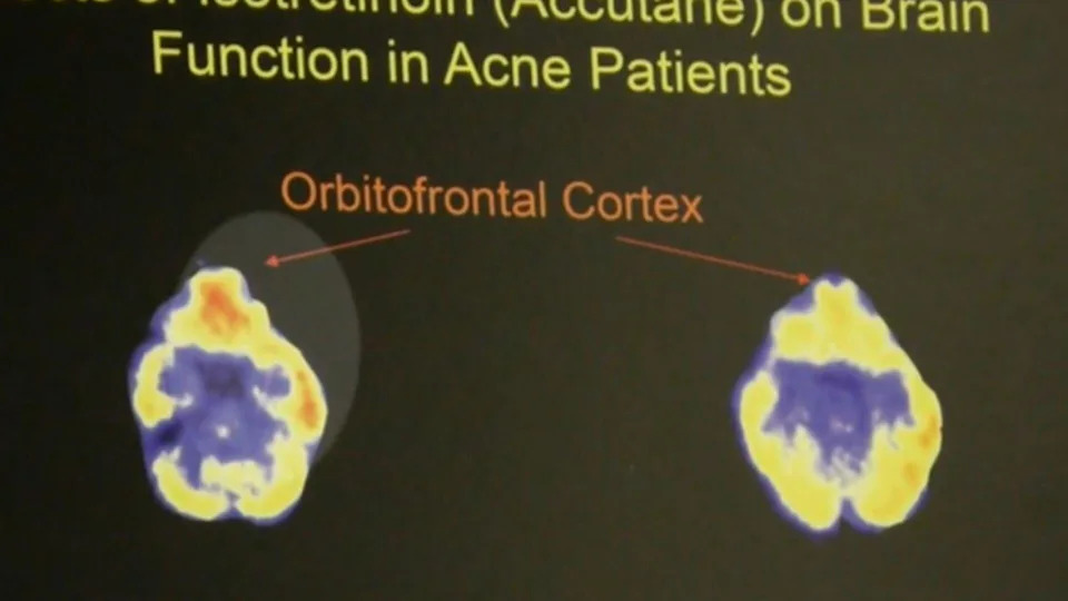 Did Accutane Drive a Texas Teen to Shoot His Friends? The Friendswood Case and the Contested Defense