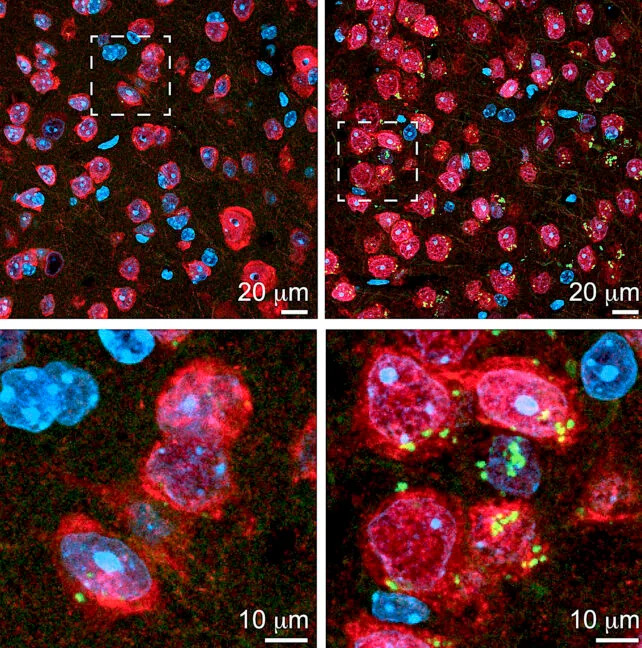 Slabiji „sistem za otpad” u mozgu može objasniti porast rizika od Alchajmerove bolesti sa starenjem