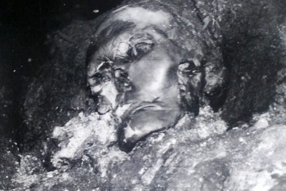 Drevna hirurgija spasila život: Otkrivena složena operacija vilice stara 2.500 godina