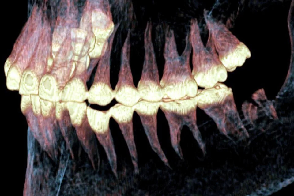 Drevna hirurgija spasila život: Otkrivena složena operacija vilice stara 2.500 godina