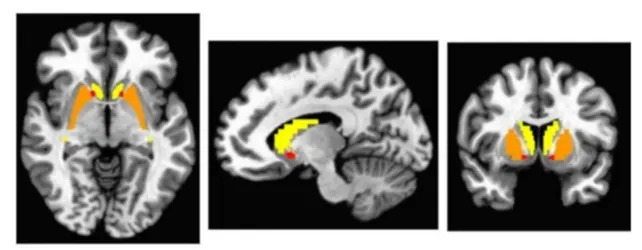 Nova Studija Povezuje Autizam Sa Promenama Transportera Dopamina — Mogući Rani Signal Za Parkinsonovu?
