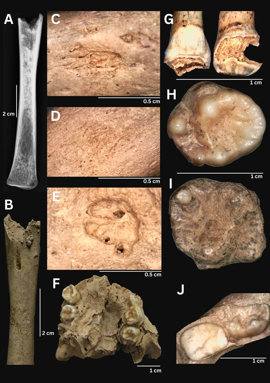 Zubi Drevne Dece Otkrivaju: Treponemska Bolest Slična Sifilisu Širila Se Vijetnamom Pre ~4.000 Godina