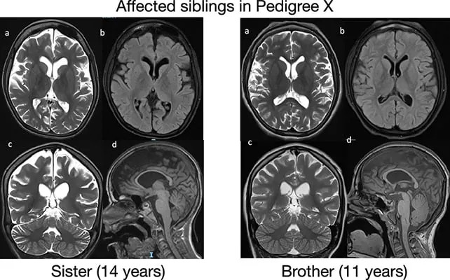 Otkriven ReNU2: Novi Recesivni Neurorazvojni Sindrom Povezan Sa Genom RNU2-2