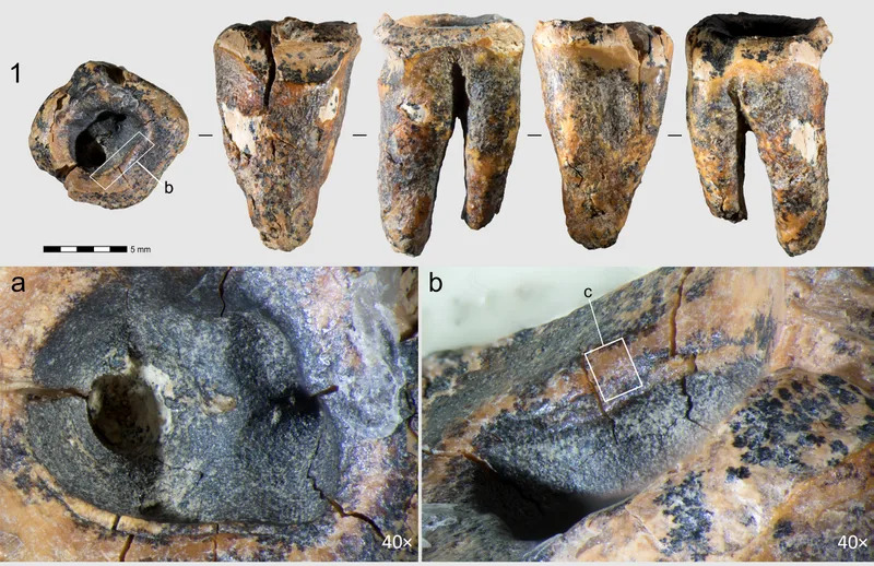 Neandertalci Su Pre 59.000 Godina Bušili Zub Da Ublaže Bol — Najstariji Dokaz Dentalne Intervencije