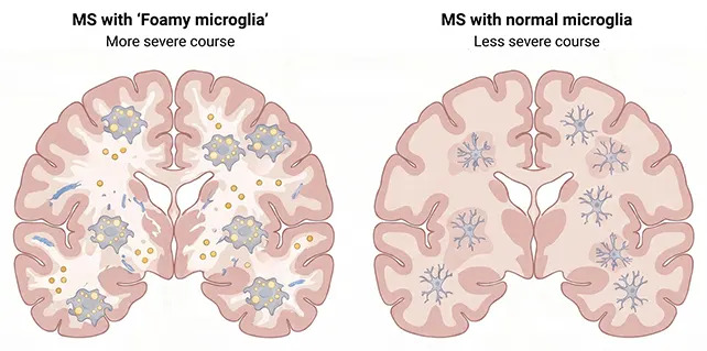 Svetski dan MS: „Penaste“ mikroglije mogle bi objasniti najteže oblike multiple skleroze