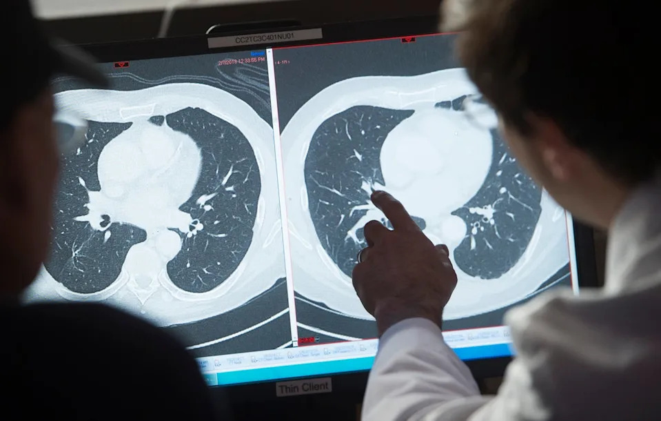 Amivantamab Može Uništiti Tumore: Potpune Remisije U Kliničkom Ispitivanju