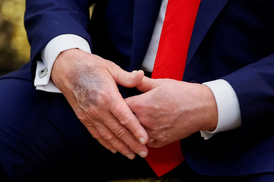 Trump Nears 80: Renewed Scrutiny Over Health as He Joins Biden in Octogenarian Presidents' Club