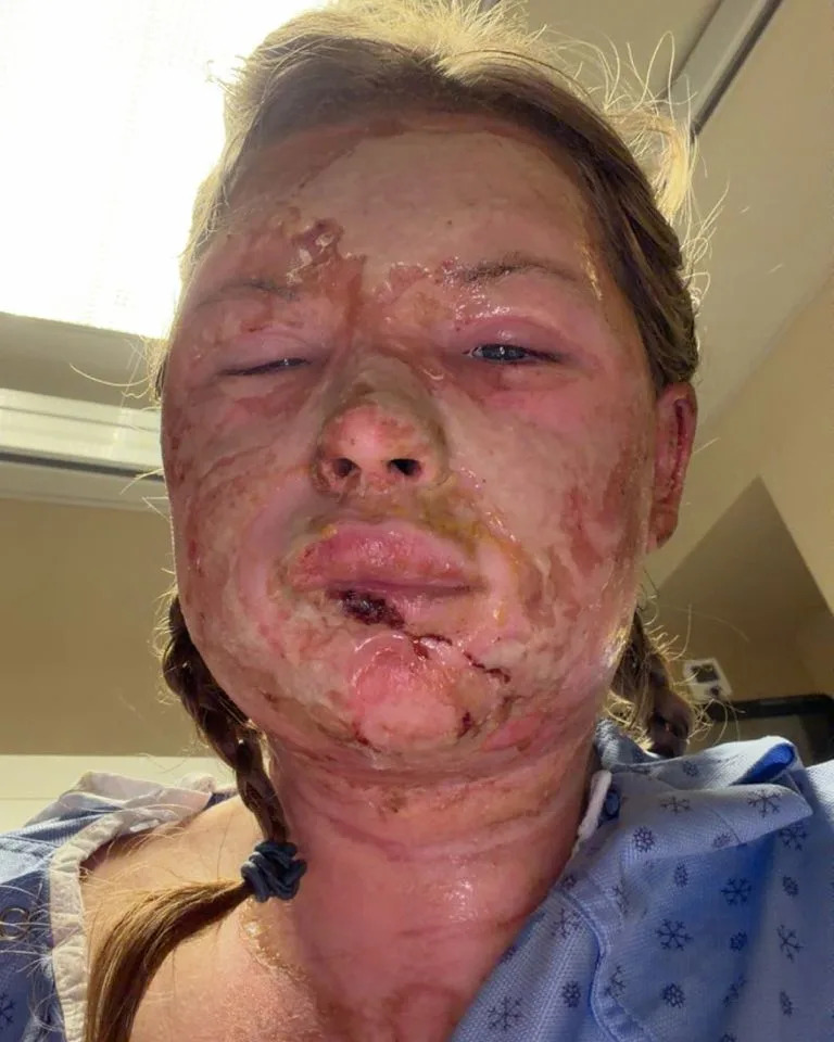 Studentkinja (18) Oporavila Se Nakon Eksperimentalne Terapije Egzomima — Prvi Takav Slučaj U Svetu