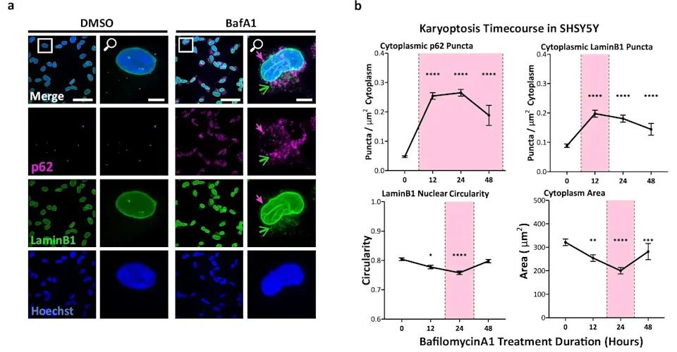 Otkriven Novi Mehanizam Smrti Neurona u Alchajmerovoj Bolesti: Karyoptosis i uloga p38 MAP Kinaze