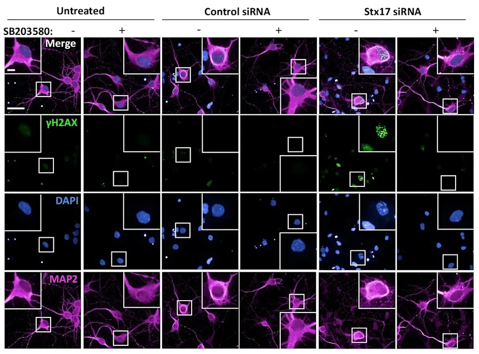 Otkriven Novi Mehanizam Smrti Neurona u Alchajmerovoj Bolesti: Karyoptosis i uloga p38 MAP Kinaze