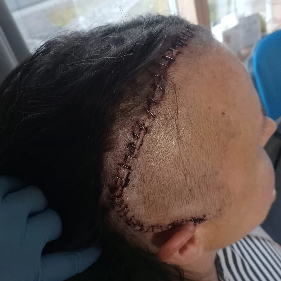 Žena tvrdi da je Depo‑Provera izazvala tri meningioma — stotine žena traže odgovore