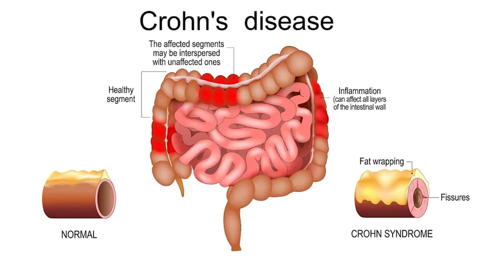 Inflamatorna bolest creva reproducirana na čipu: Colon Chip otkriva ključnu ulogu fibroblasta