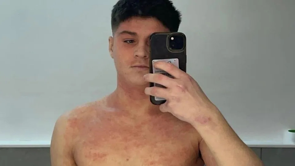 Prekid Steroidne Kreme Ostavio Fudbalera Prikovanog Za Krevet: 