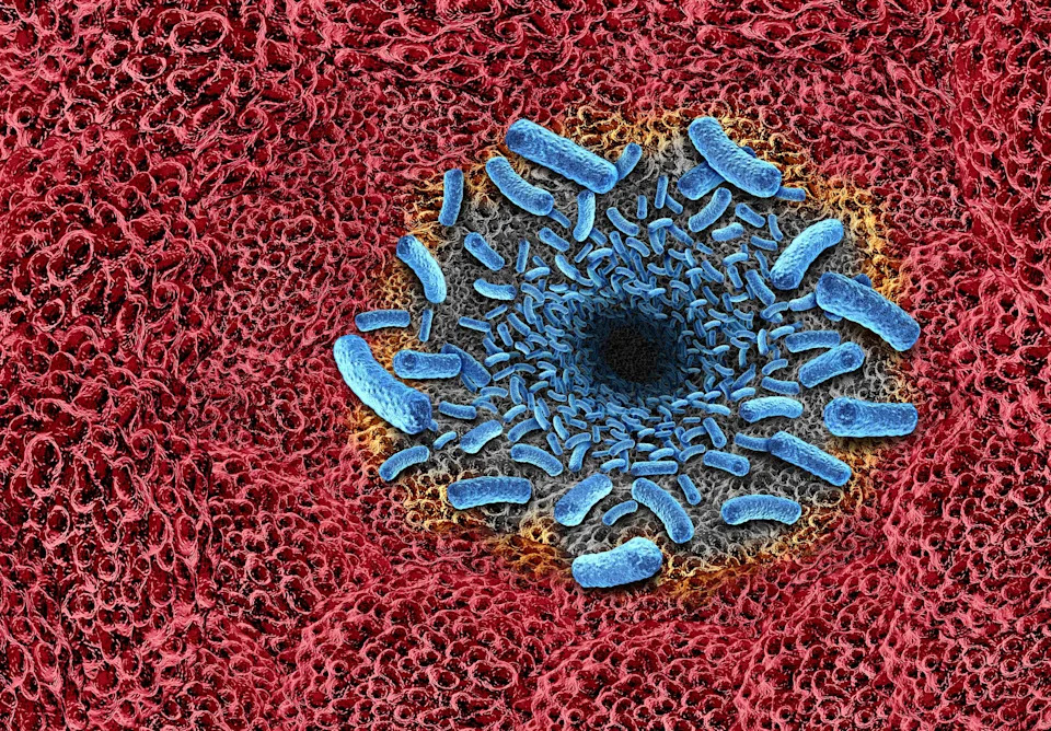 Florida Reports First 2026 Death From Rare Flesh‑Eating Bacteria Amid Rising Cases