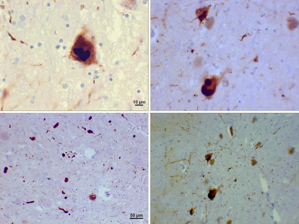 Sintetička molekula SK-129 Razbija Toksične Nakupine Alfa‑sinukleina i Smanjuje Simptome Parkinsonove Bolesti