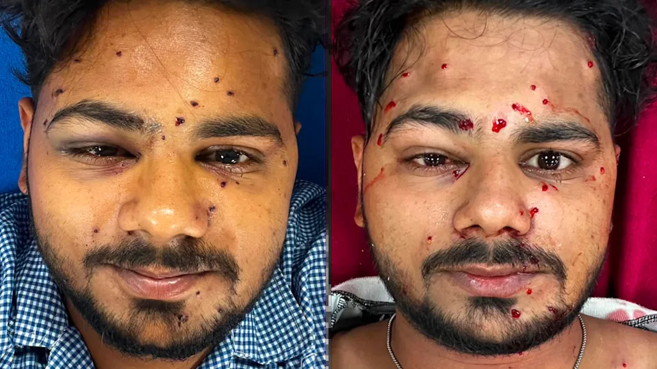Eksperti: Povrede kod demonstranata u Delhiju ukazuju na ranjavanja od patron‑puški