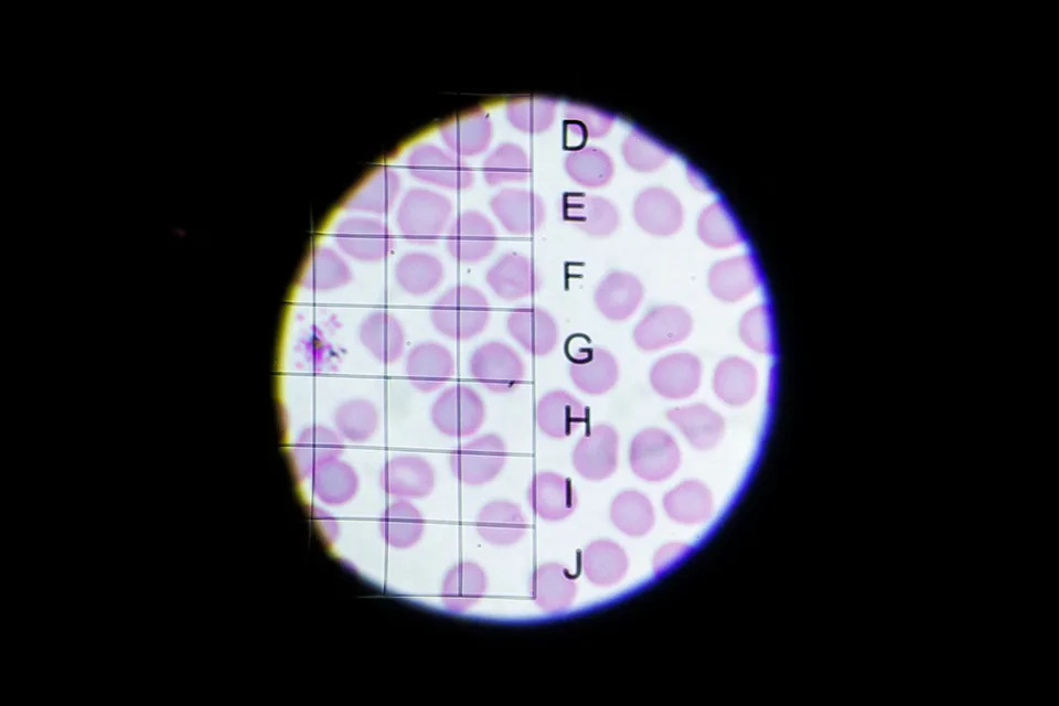 Oksford Testira Kombinovanu Vakcinu RH5.1+R78C Koja Cilja Malariju U Jetri I Krvi