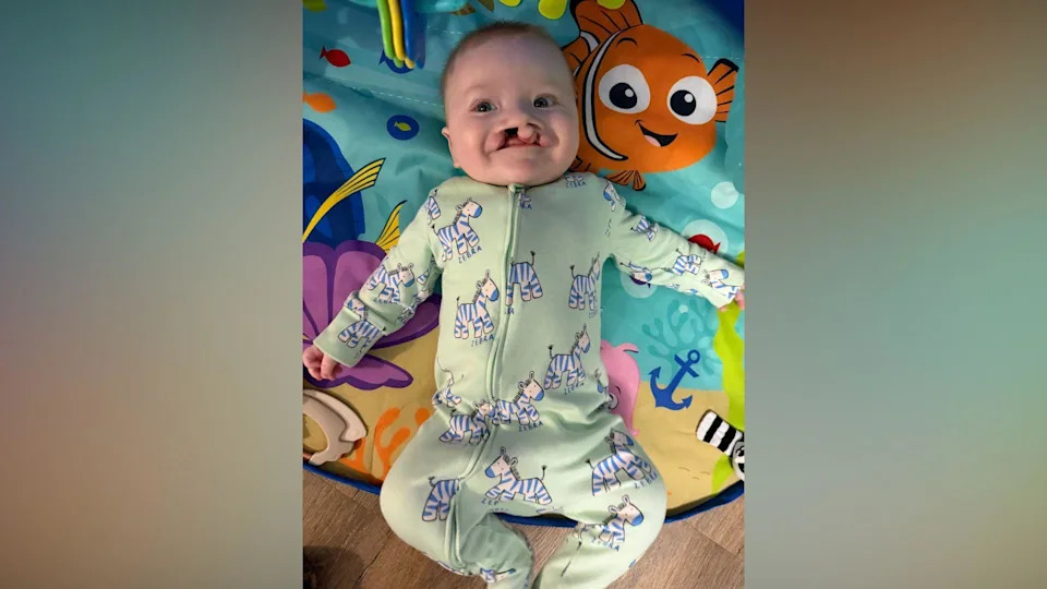 Father Fears Time-Critical Cleft Surgery Delay After Northern Ireland's Only Specialist Resigns
