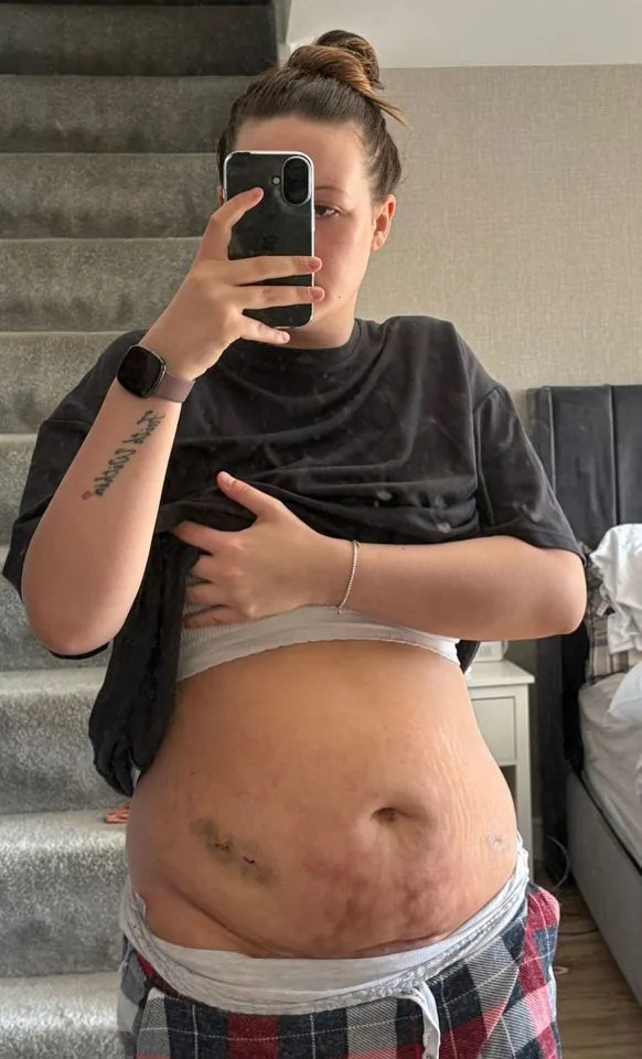 Sestre Godinama Ignorisane: Liv i Molly Smith Dobile Dijagnozu Endometrioze Nakon Laparoskopije
