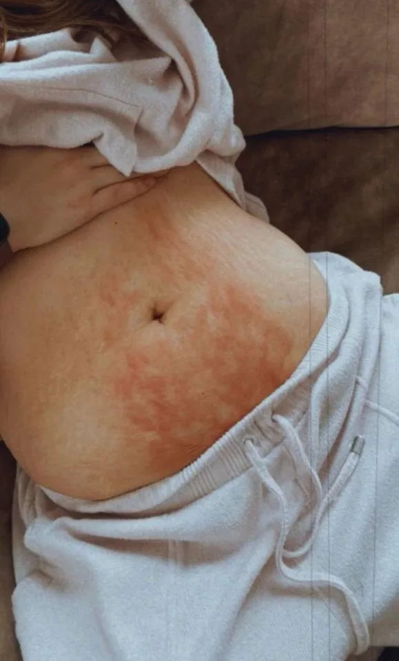 Sestre Godinama Ignorisane: Liv i Molly Smith Dobile Dijagnozu Endometrioze Nakon Laparoskopije
