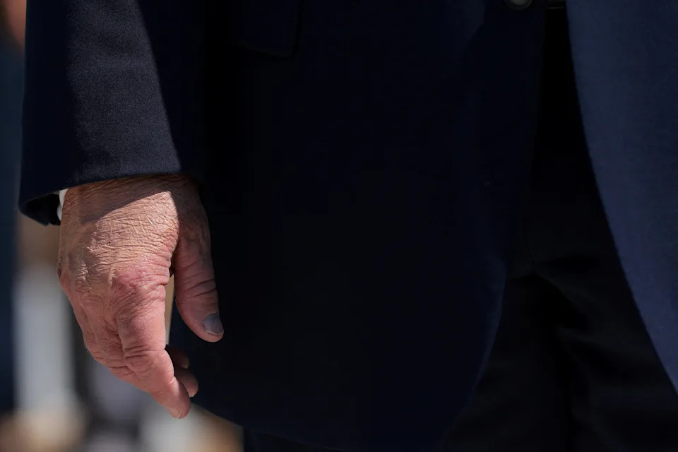 Photos Show Trump’s Swollen, Discolored Right Hand During White House Events