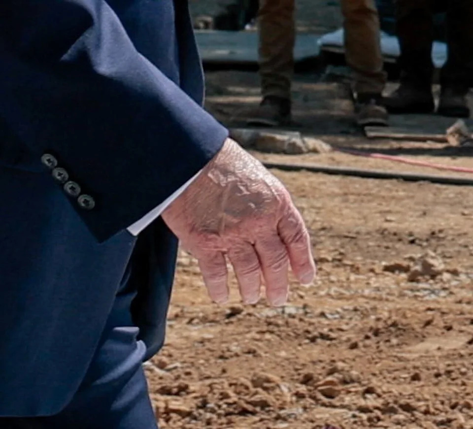 Photos Show Trump’s Swollen, Discolored Right Hand During White House Events