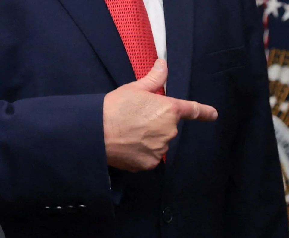 Photos Show Trump’s Swollen, Discolored Right Hand During White House Events