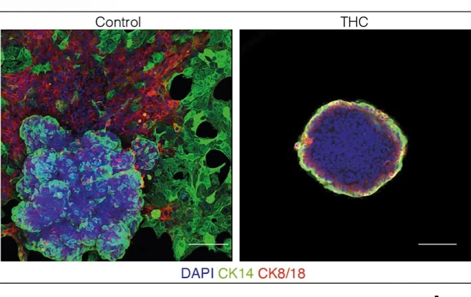 Otkriven Receptor Kanabisa Koji Može Smanjiti Širenje Raka Dojke — Novi Preklinički Rezultati