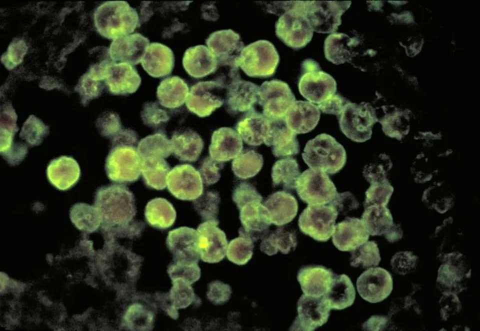 Tinejdžer Iz Severne Karoline Kritično Zbog Naegleria fowleri — Stručnjaci Upozoravaju Na Rizik U Toplim Slatkim Vodama