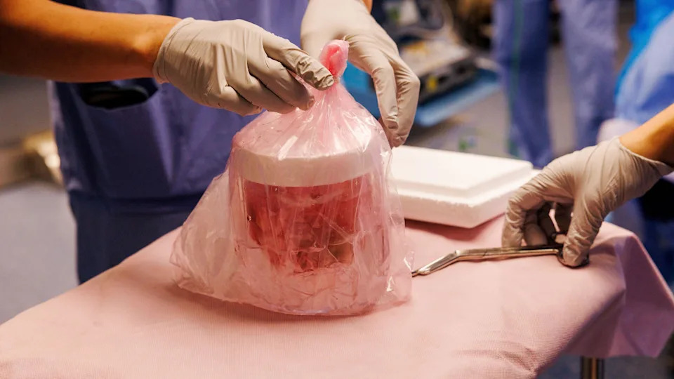 Svinjski bubreg funkcionisao rekordnih 271 dan u telu Amerikanca — kseno‑transplantacija kao „most