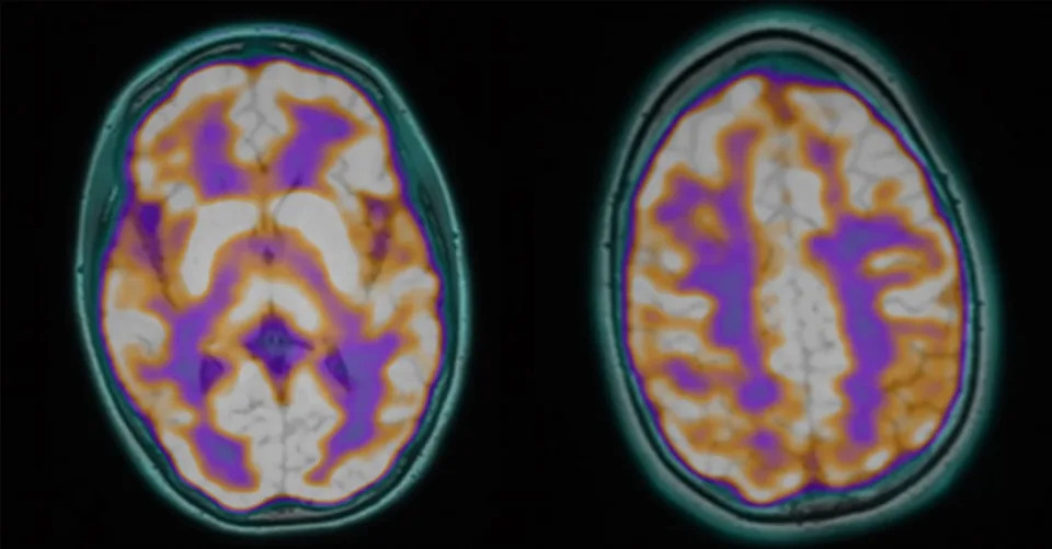 Misterija Posle Smrti: DNK Babesije i Bartonelle Pronađen U Pet Od Šest Mladih — Može Li Infekcija Objasniti Psihijatrijske Simptome?