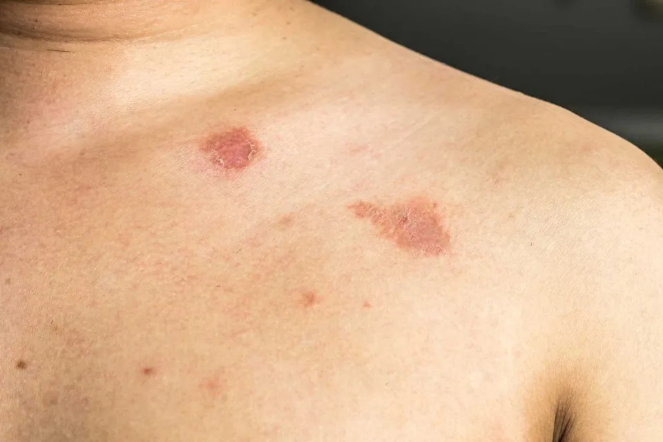 Rastu Slučajevi Otporne Gljivice <i>Trichophyton indotineae</i> — Novi Izazov Za Javno Zdravlje