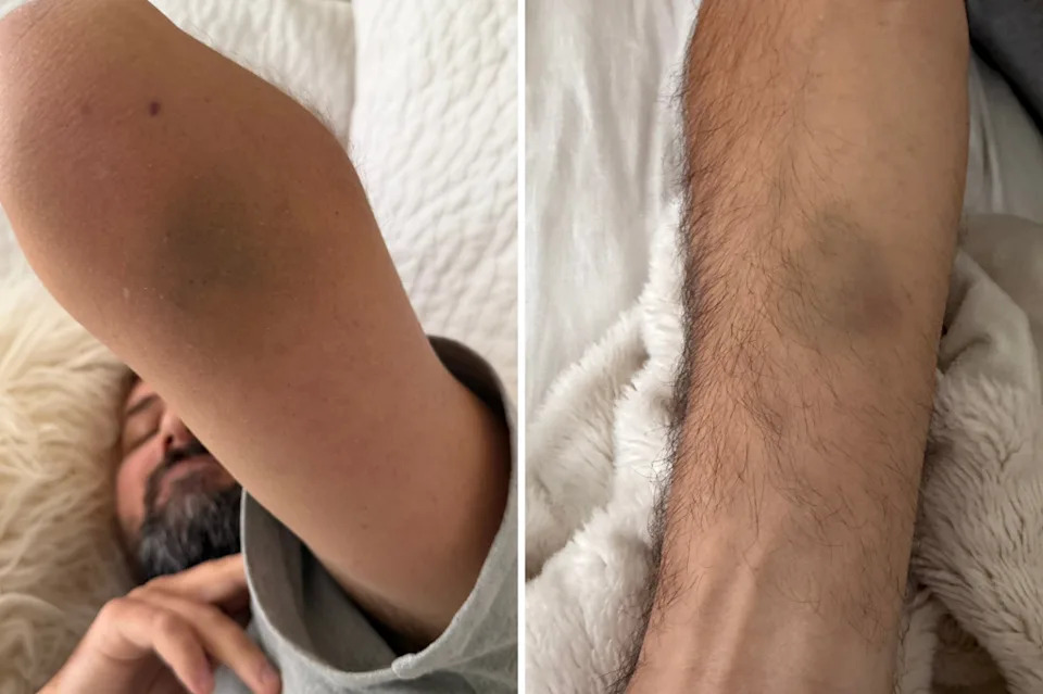 Neobjašnjive Modrice Otkrile Tešku Dijagnozu: Reese (40) Imao Trombocite 5.000 — Dijagnostikovan AML
