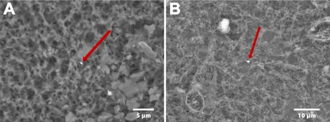 Metal Debris From Joint Replacements Detected in Human Brains — Cobalt Linked to Alzheimer’s Protein Build-Up