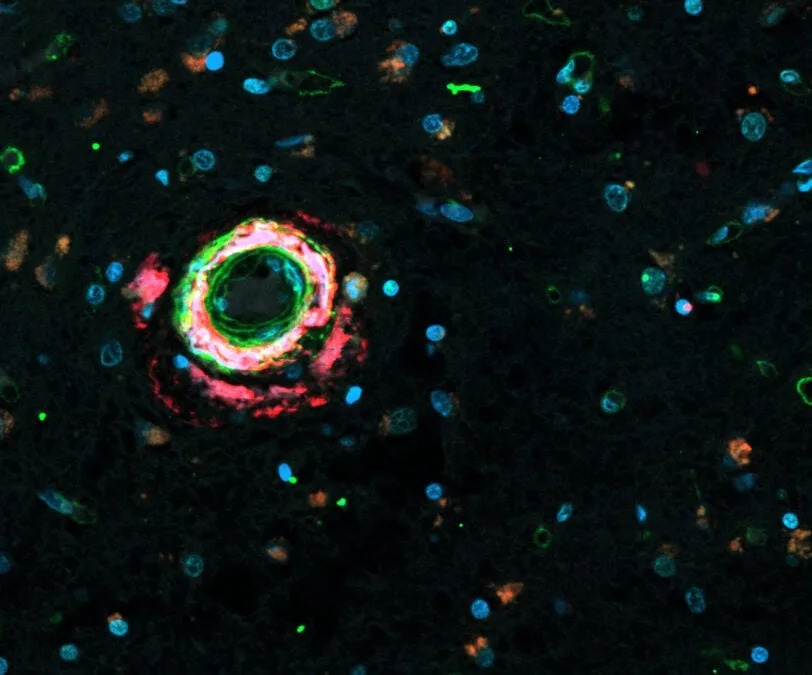 Scientists Repair Leaky Blood–Brain Barrier In Alzheimer’s Models By Targeting Fibronectin
