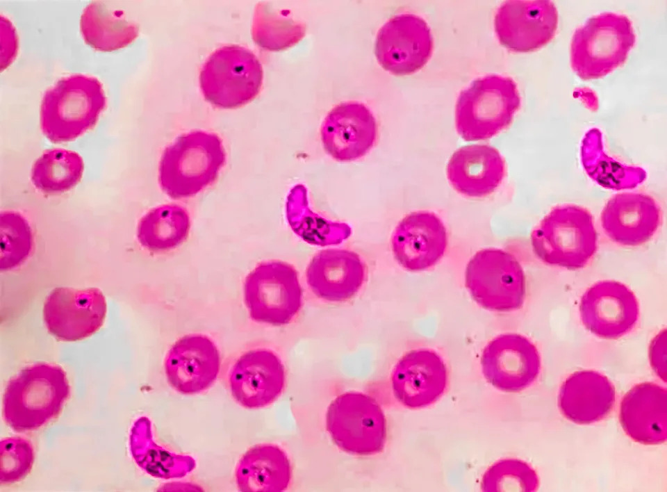 Rare 'Airport Malaria' Outbreak Near Frankfurt Airport Kills Three